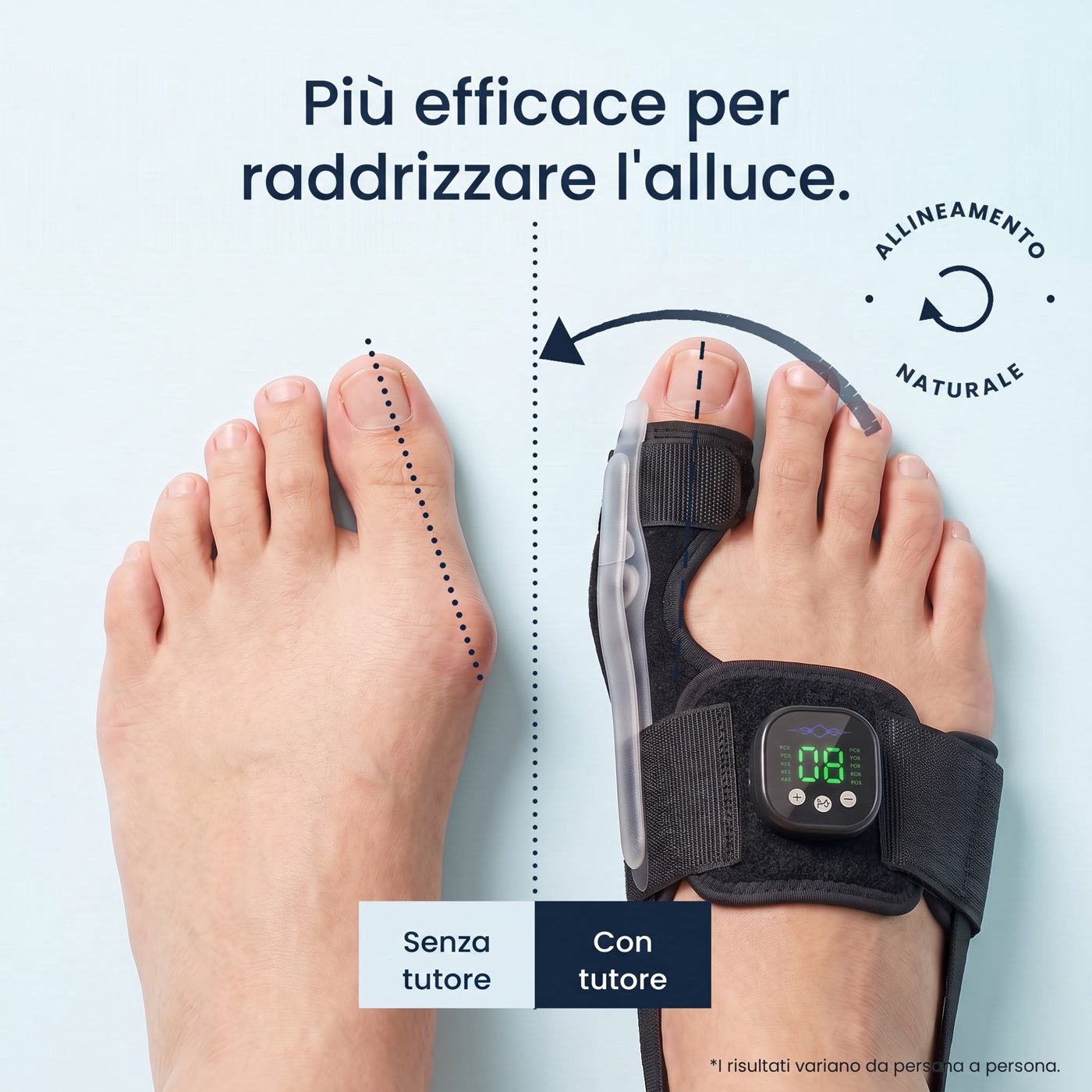 Tutore EMS per Alluce Valgo Kevula